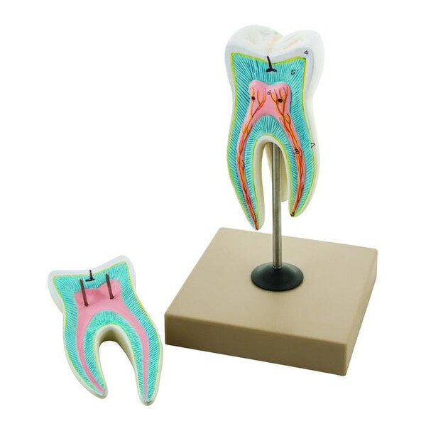 Eisco Scientific Upper Triple Root Molar w/Caries Model, Enlarged 15 Times, 2 Parts - AM0046